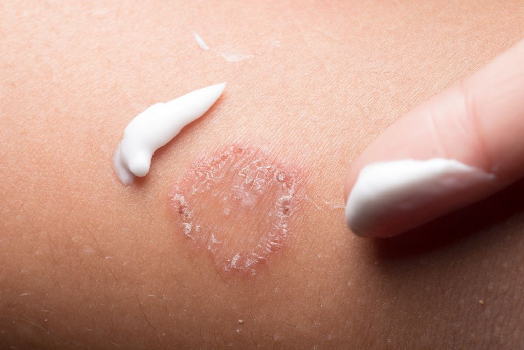 Erisipela e Celulite: Compreendendo as Infecções da Pele